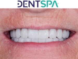 Premium Dental Implants in Istanbul, Turkey by DentSpa — Dentistry in Turkey