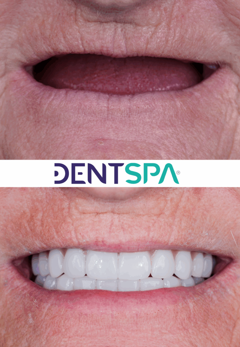 Premium Dental Implants in Istanbul, Turkey by DentSpa