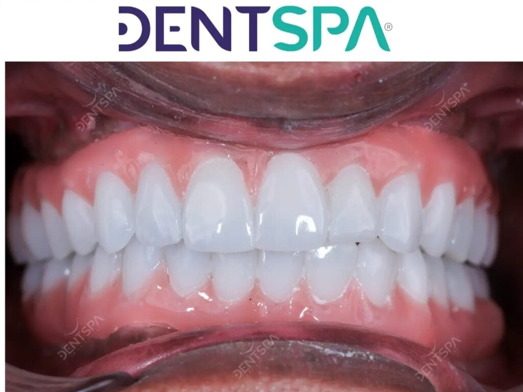 Premium Root Canal in Istanbul, Turkey by DentSpa — Dentistry Procedure in Turkey