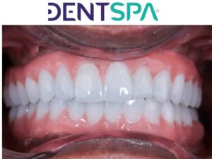 Premium Root Canal in Istanbul, Turkey by DentSpa — Dentistry in Turkey