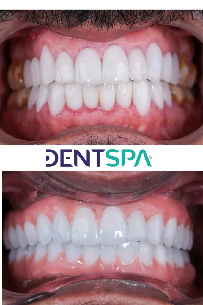 Premium Root Canal in Istanbul, Turkey by DentSpa — Dentistry Procedure in Turkey