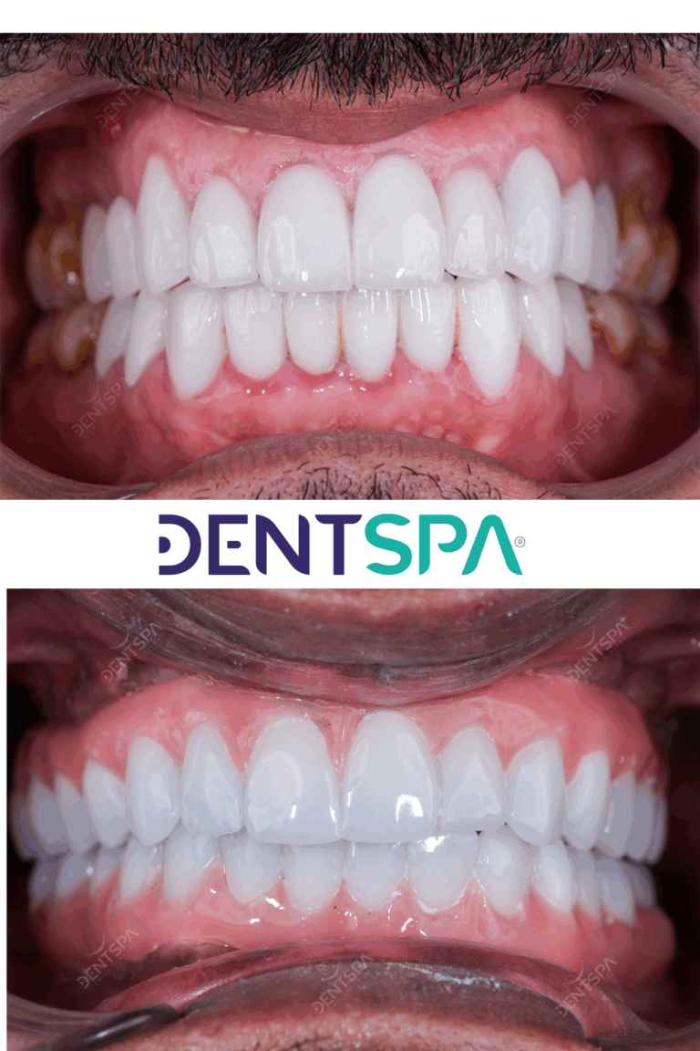 Premium Root Canal in Istanbul, Turkey by DentSpa