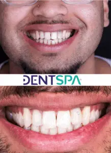 Premium Lip Repositioning in Istanbul, Turkey by DentSpa