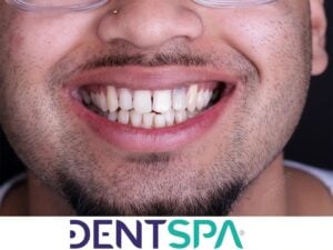 Premium Lip Repositioning in Istanbul, Turkey by DentSpa — Dentistry in Turkey