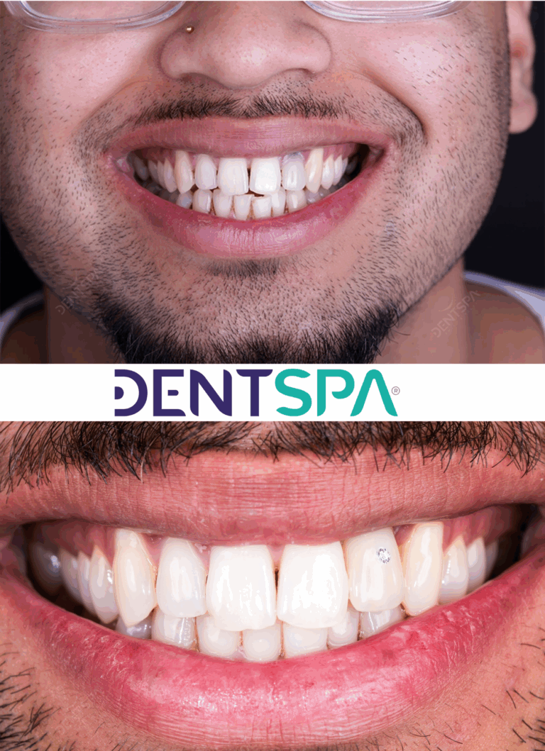 Premium Lip Repositioning in Istanbul, Turkey by DentSpa