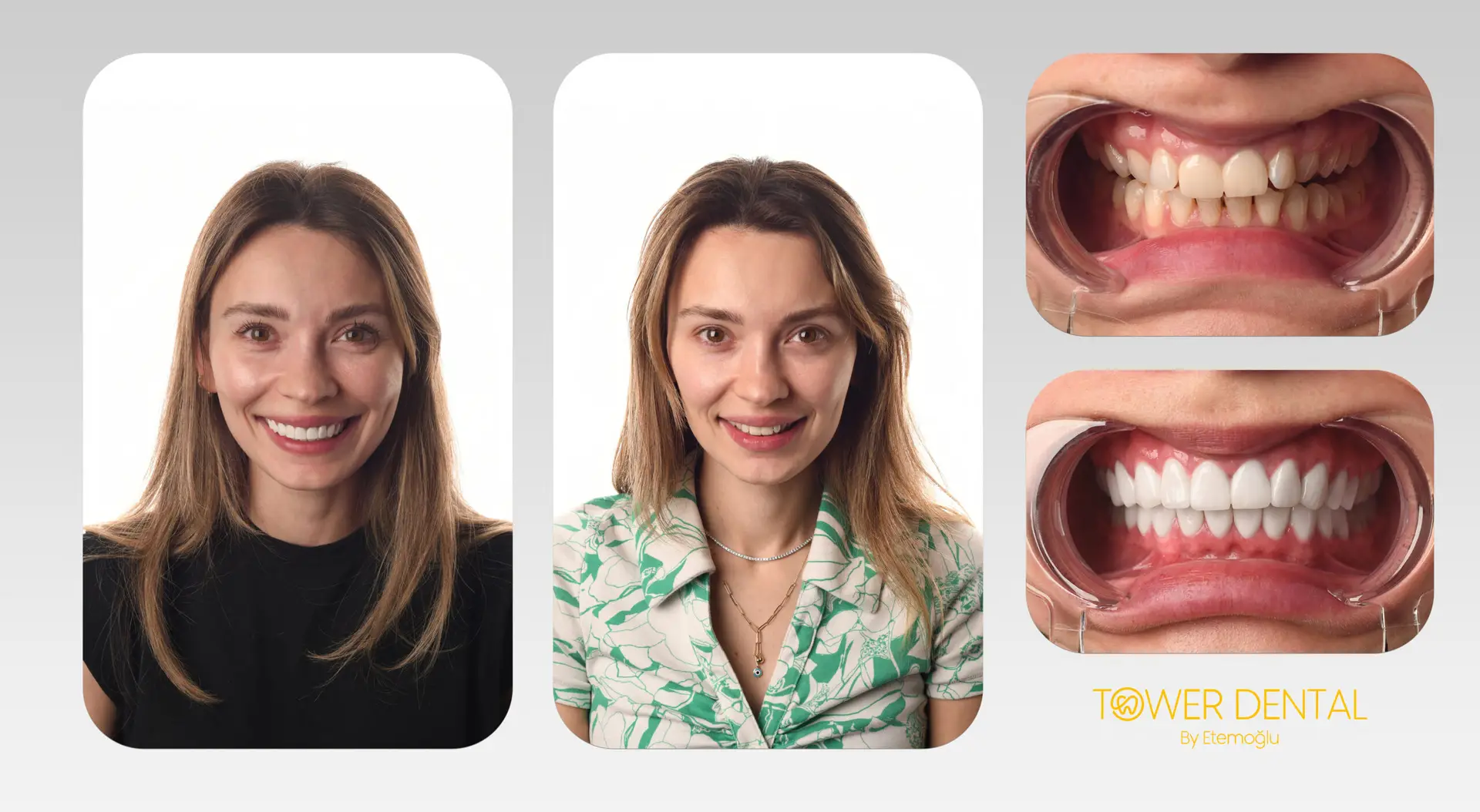 E.Max Dental Veneers in Istanbul, Turkey by Tower Dental Clinic