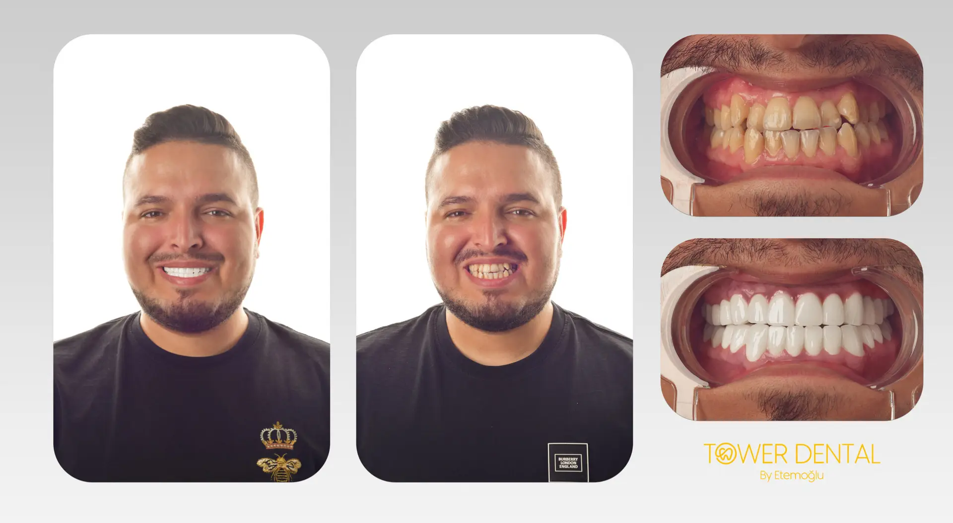 E.Max Dental Veneers in Istanbul, Turkey by Tower Dental Clinic