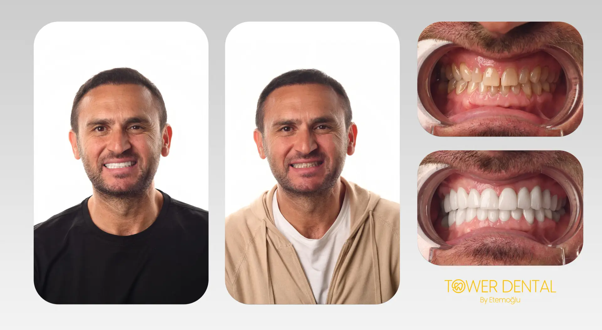 E.Max Dental Veneers in Istanbul, Turkey by Tower Dental Clinic