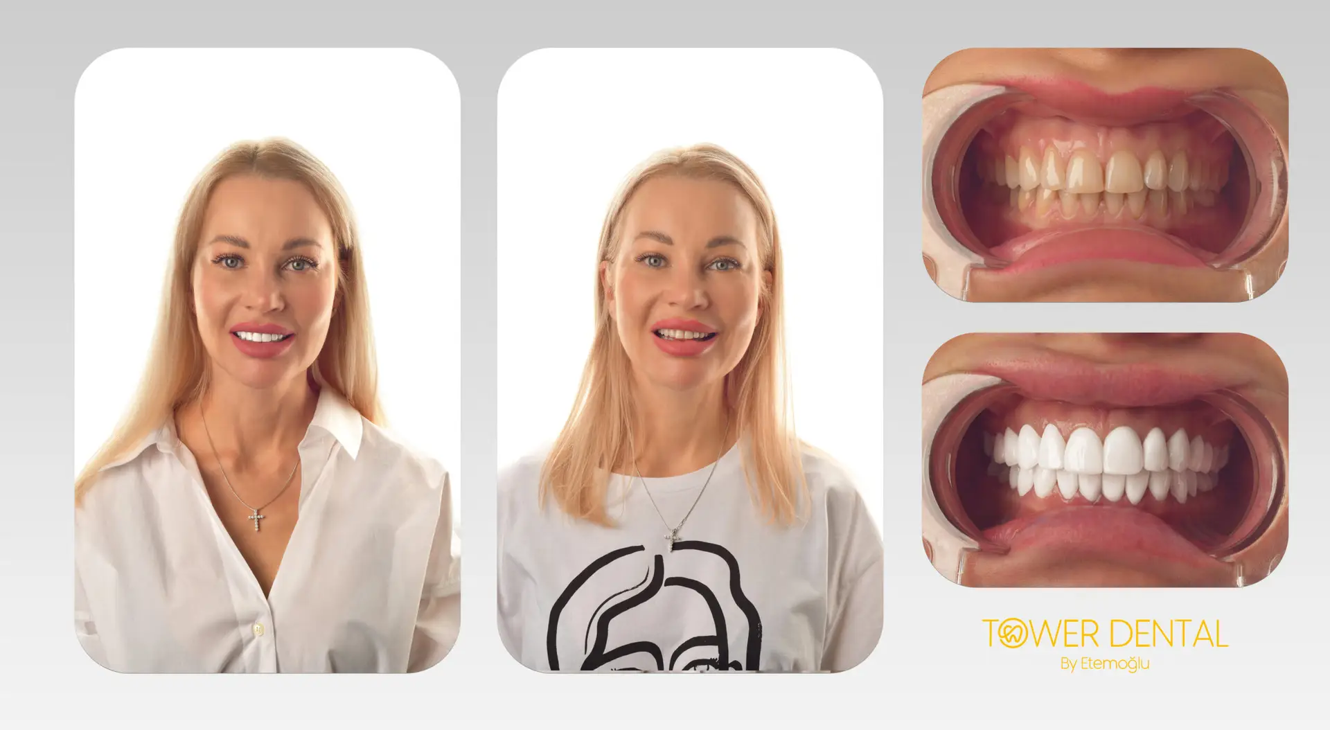 E.Max Dental Veneers in Istanbul, Turkey by Tower Dental Clinic