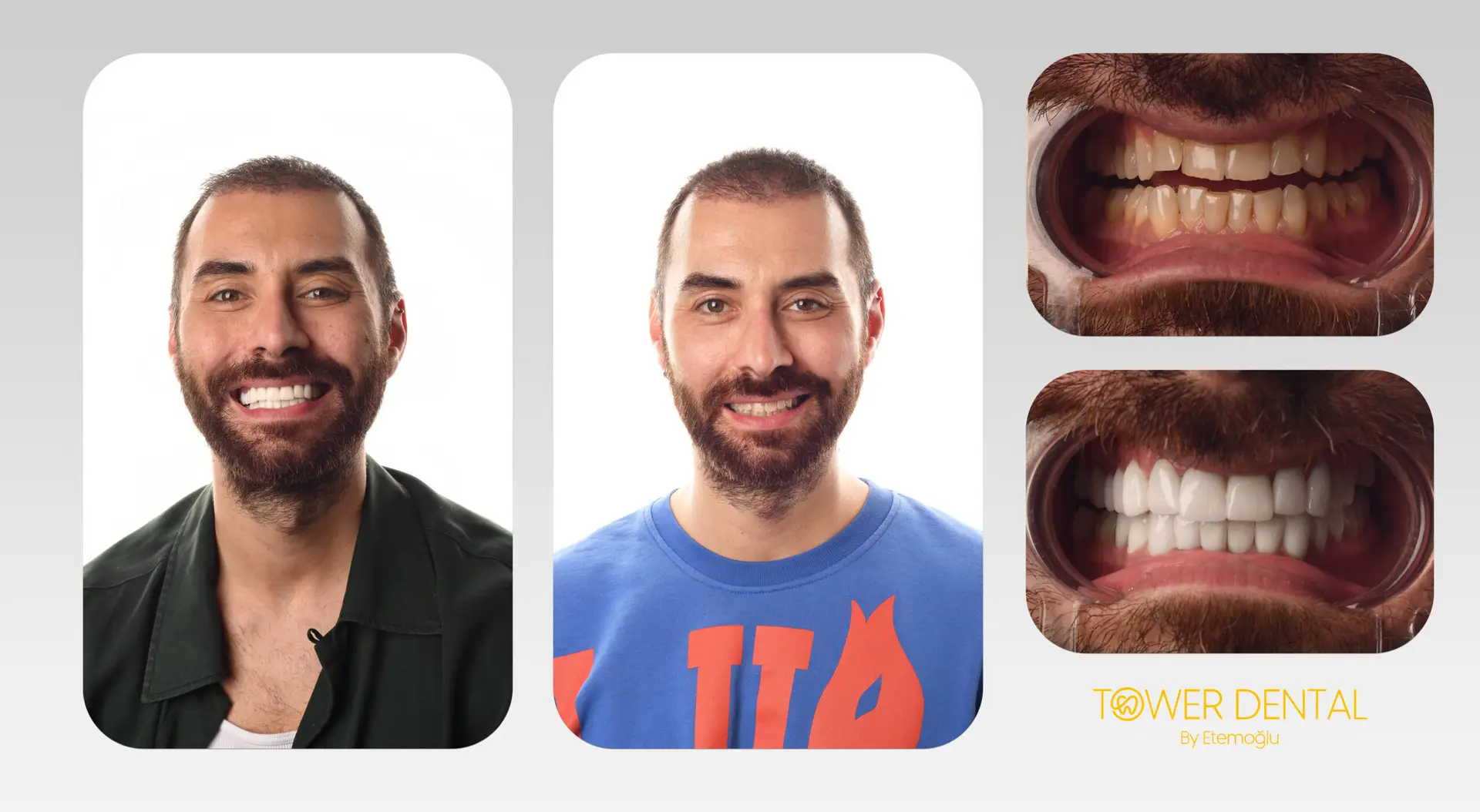 E.Max Dental Veneers in Istanbul, Turkey by Tower Dental Clinic