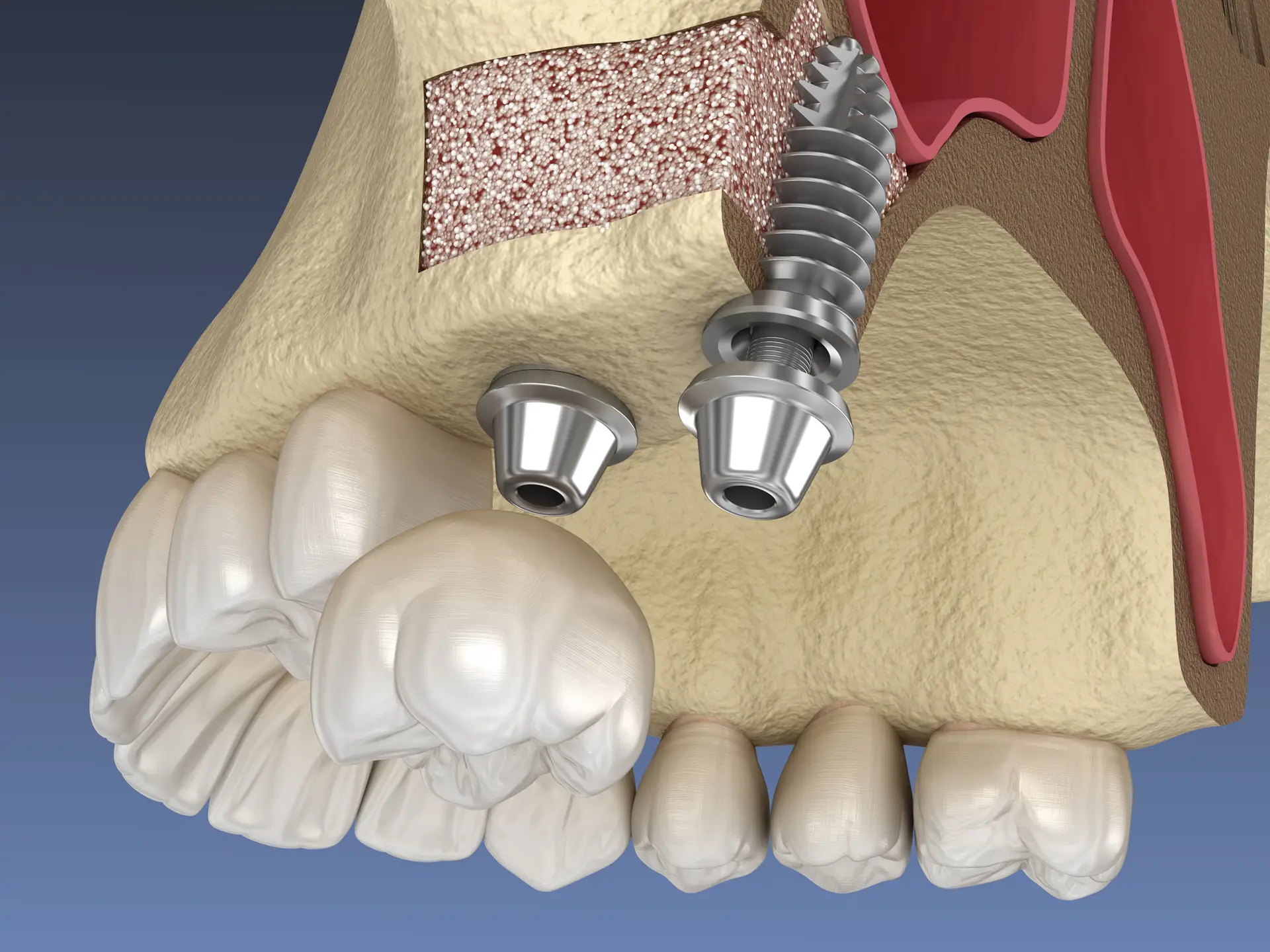 Sinus Lifting and Bone Grafting in Istanbul, Turkey by Tower Dental Clinic