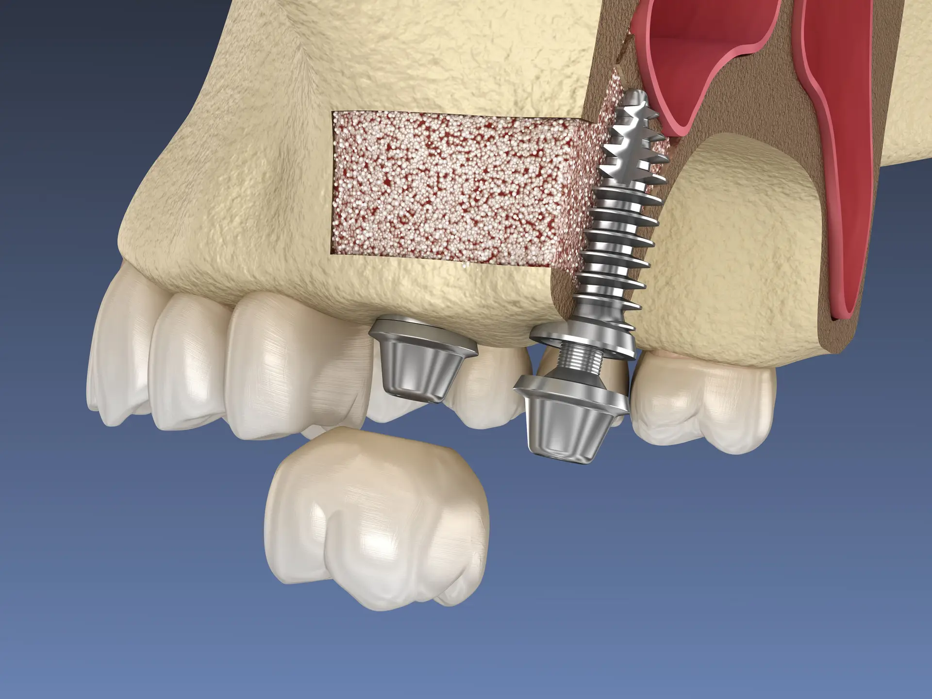 Sinus Lifting and Bone Grafting in Istanbul, Turkey by Tower Dental Clinic