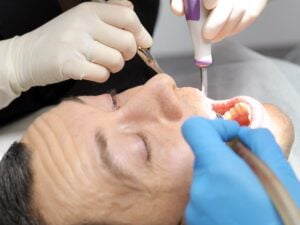 Premium Frenectomy Operation in Istanbul, Turkey by DentSpa — Dentistry in Turkey