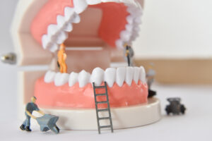 Full Mouth Rehab (up to 28 Zirconia Crowns) in Los Algodones, Mexico by Supreme Dental — Dentistry in Mexico