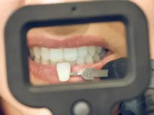 E.Max Dental Veneers in Istanbul, Turkey by Tower Dental Clinic — Dentistry in Turkey