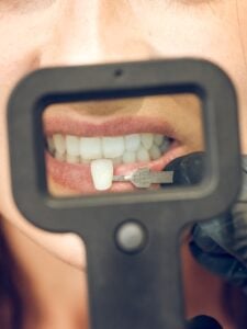 E.Max Dental Veneers in Istanbul, Turkey by Tower Dental Clinic at Tower Dental Clinic — Dentistry Procedure Abroad