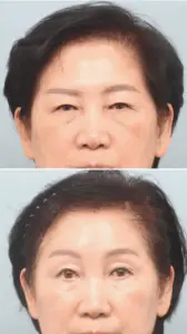 Endotine Forehead Lift in Incheon, South Korea by Elite Plastic Surgery