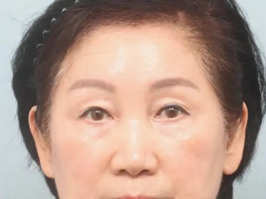 Endotine Forehead Lift in Incheon, South Korea by Elite Plastic Surgery — Plastic Surgery Procedure in South Korea