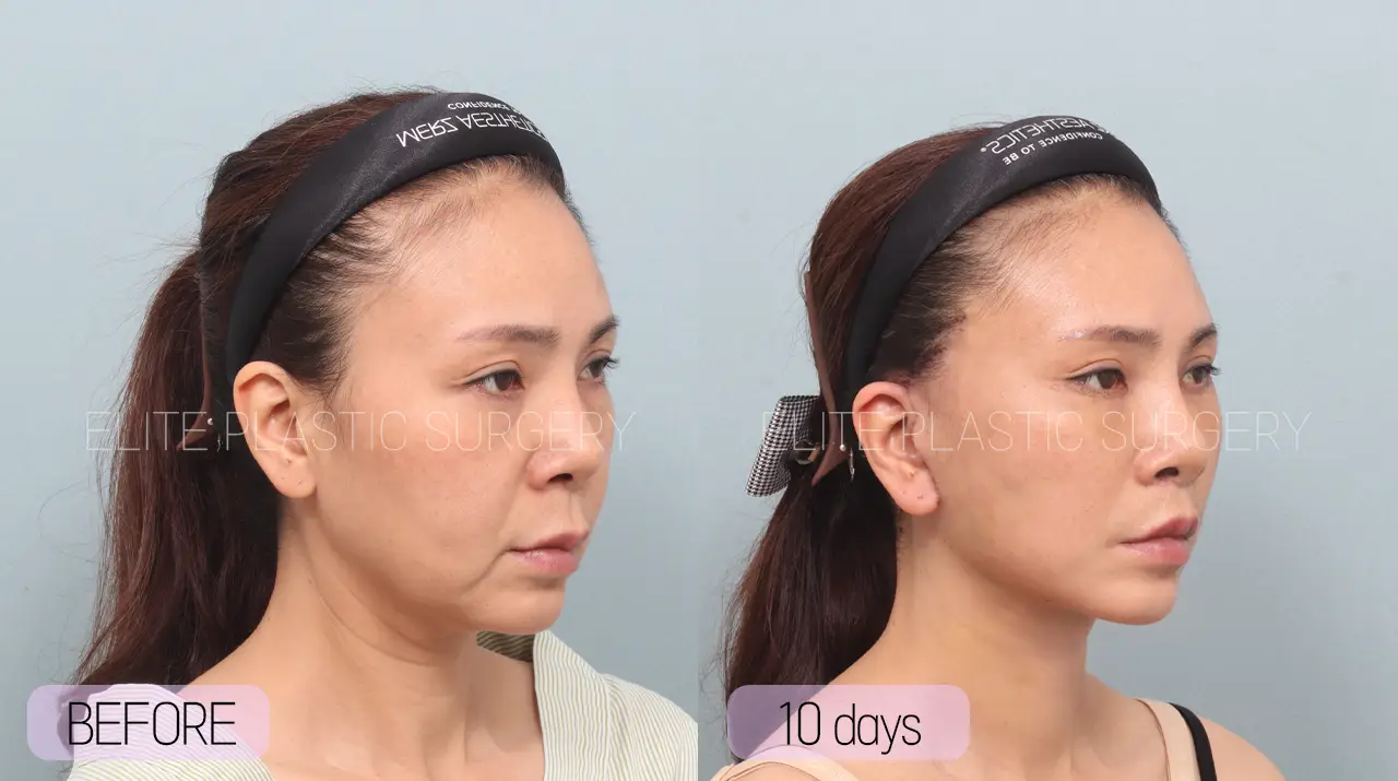 Facelift and Neck Lift in Incheon, South Korea by Elite Plastic Surgery