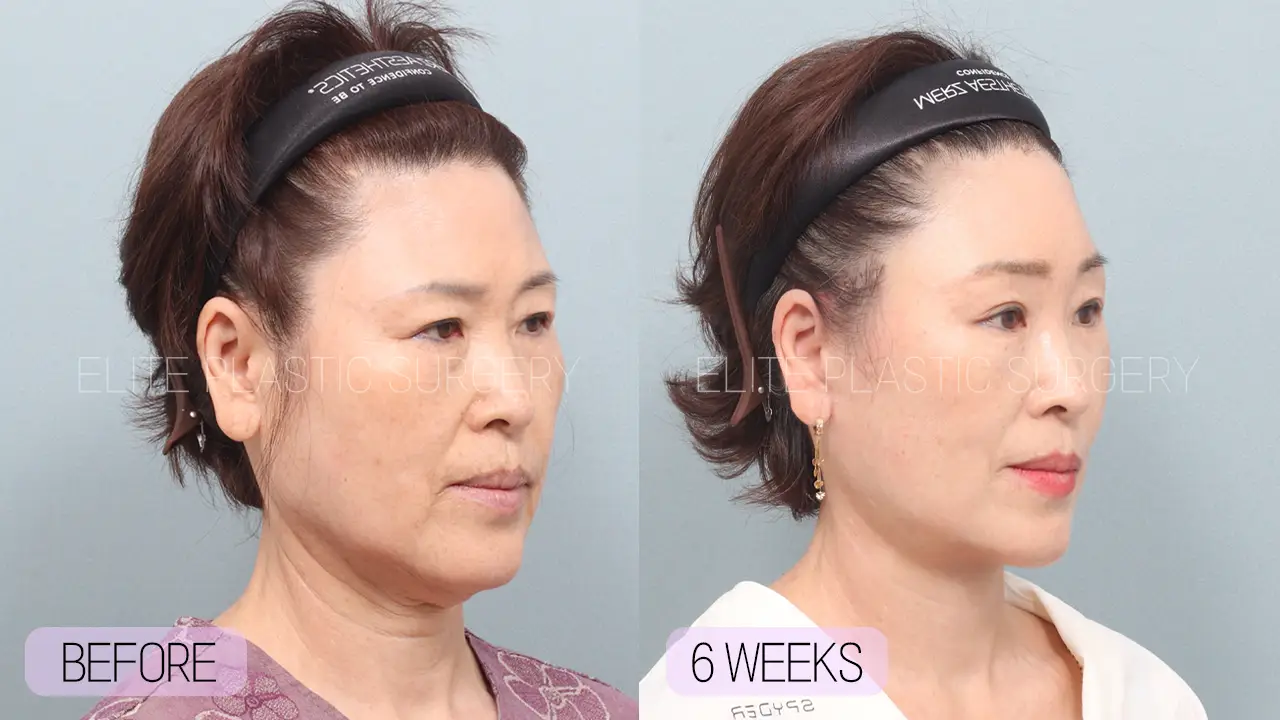 Facelift and Neck Lift in Incheon, South Korea by Elite Plastic Surgery