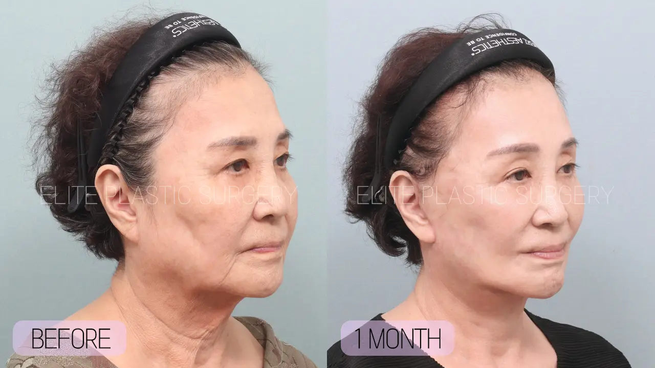 Facelift and Neck Lift in Incheon, South Korea by Elite Plastic Surgery