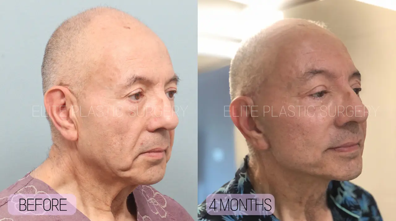 Facelift and Neck Lift in Incheon, South Korea by Elite Plastic Surgery