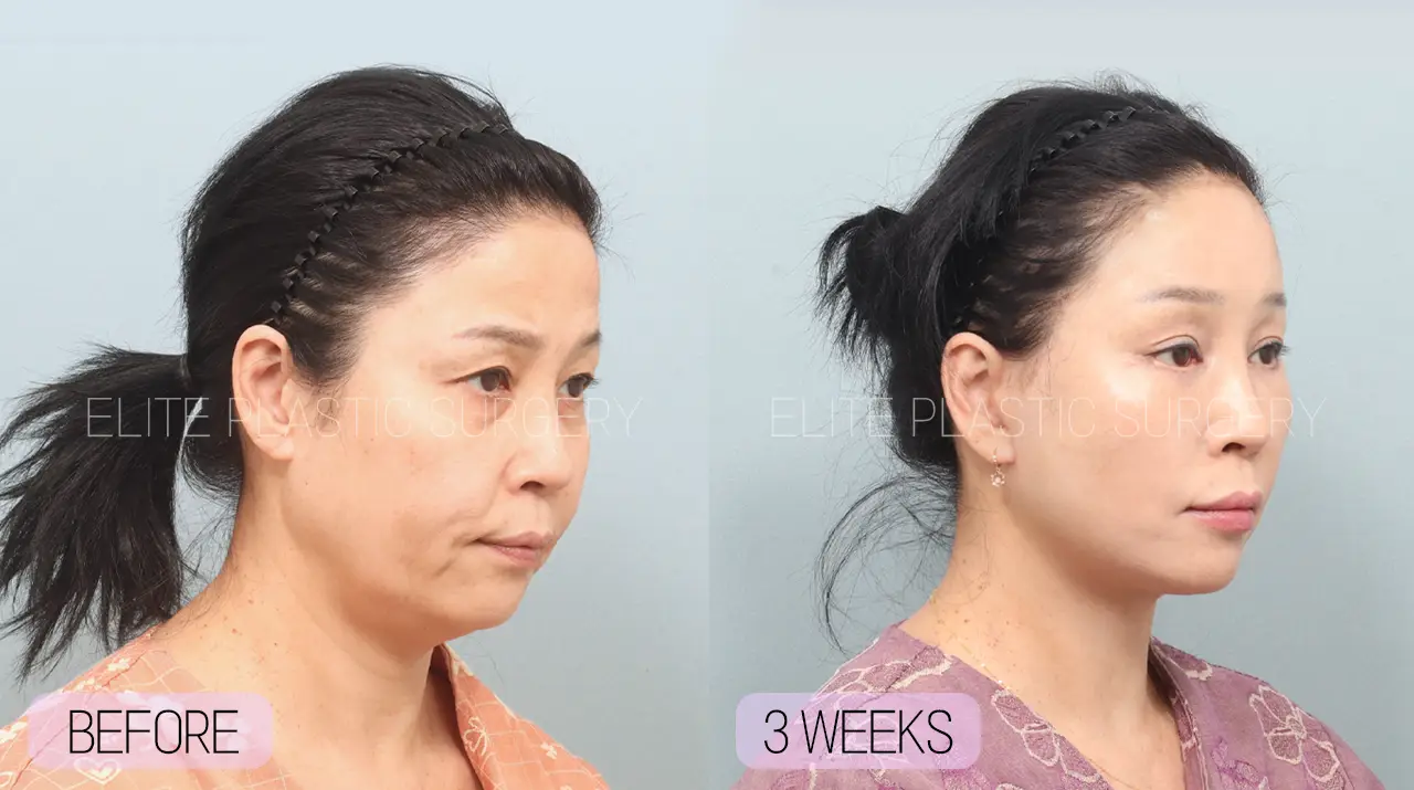 Facelift and Neck Lift in Incheon, South Korea by Elite Plastic Surgery