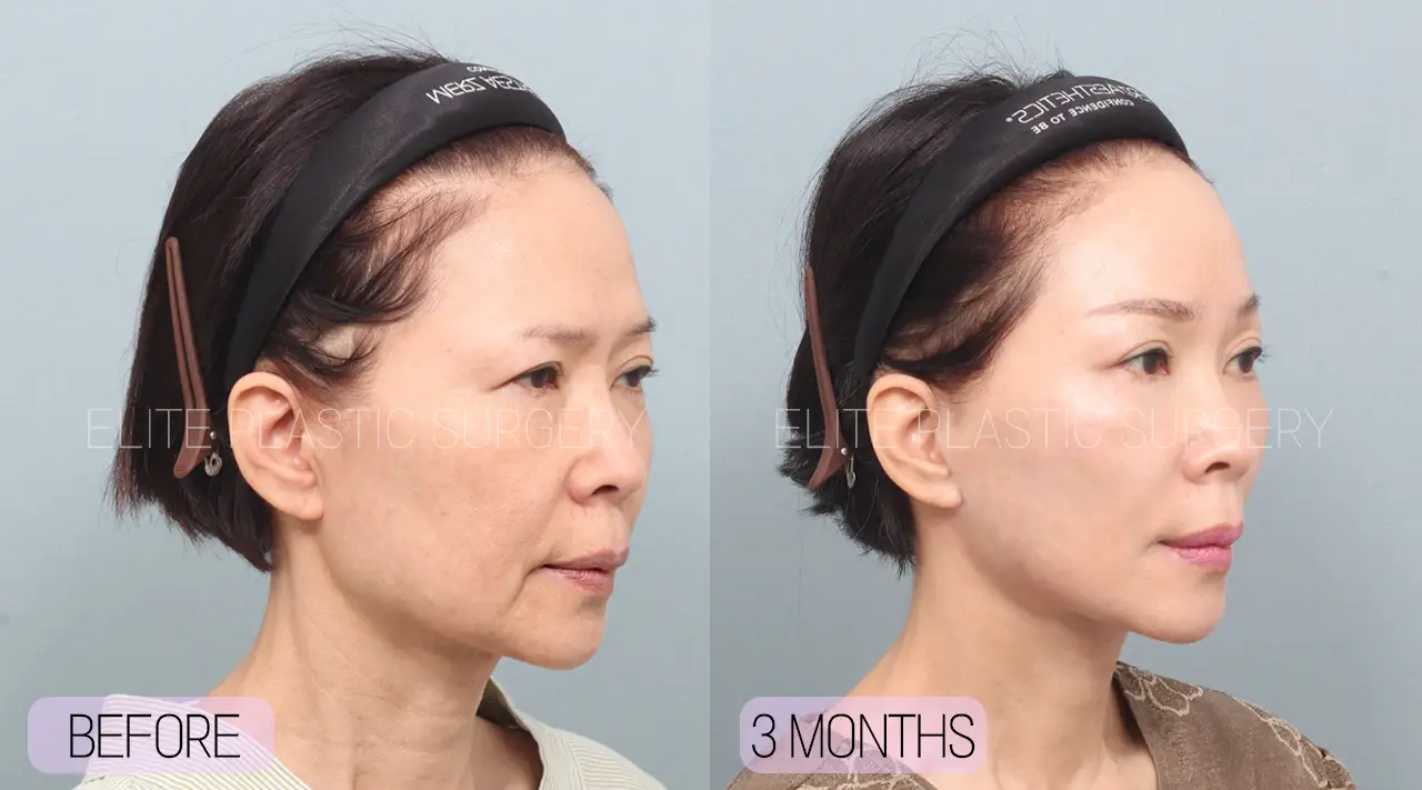 Facelift and Neck Lift in Incheon, South Korea by Elite Plastic Surgery
