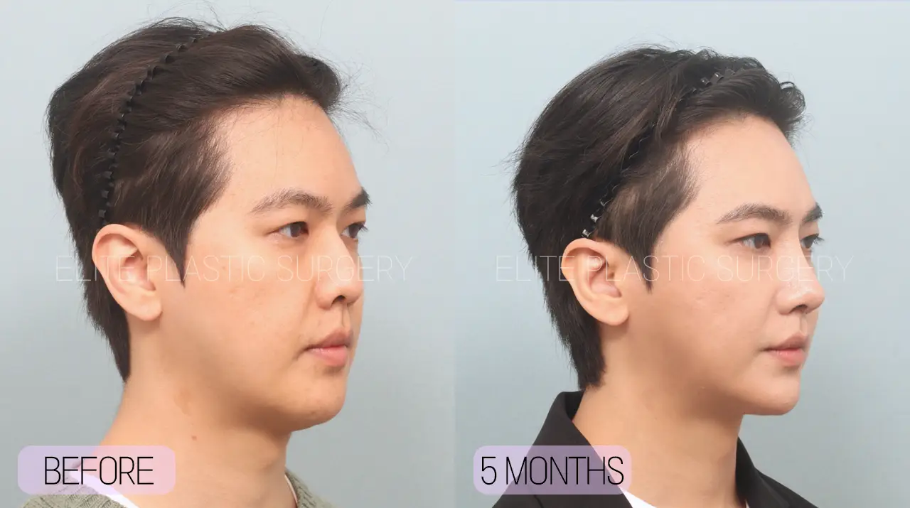 Facelift and Neck Lift in Incheon, South Korea by Elite Plastic Surgery
