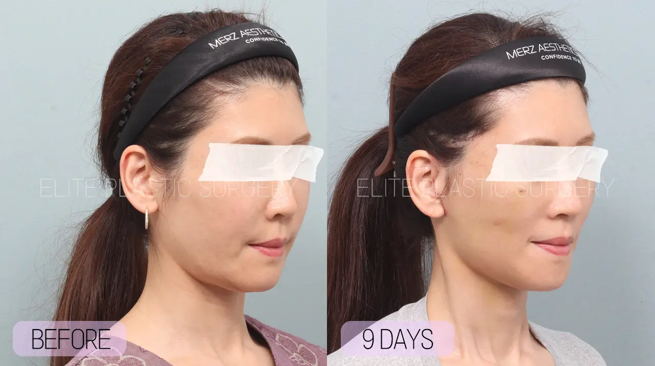 Facelift and Neck Lift in Incheon, South Korea by Elite Plastic Surgery