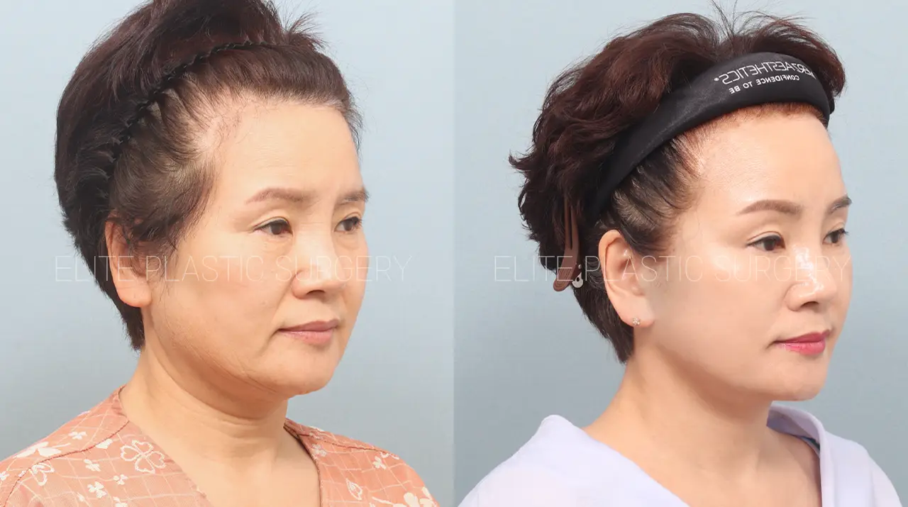Facelift and Neck Lift in Incheon, South Korea by Elite Plastic Surgery