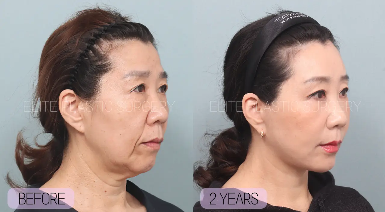 Facelift and Neck Lift in Incheon, South Korea by Elite Plastic Surgery