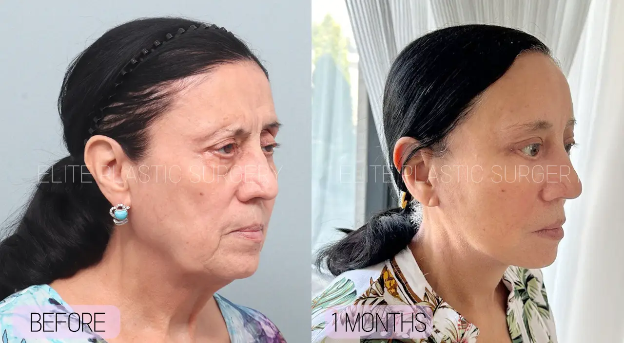 Facelift and Neck Lift in Incheon, South Korea by Elite Plastic Surgery