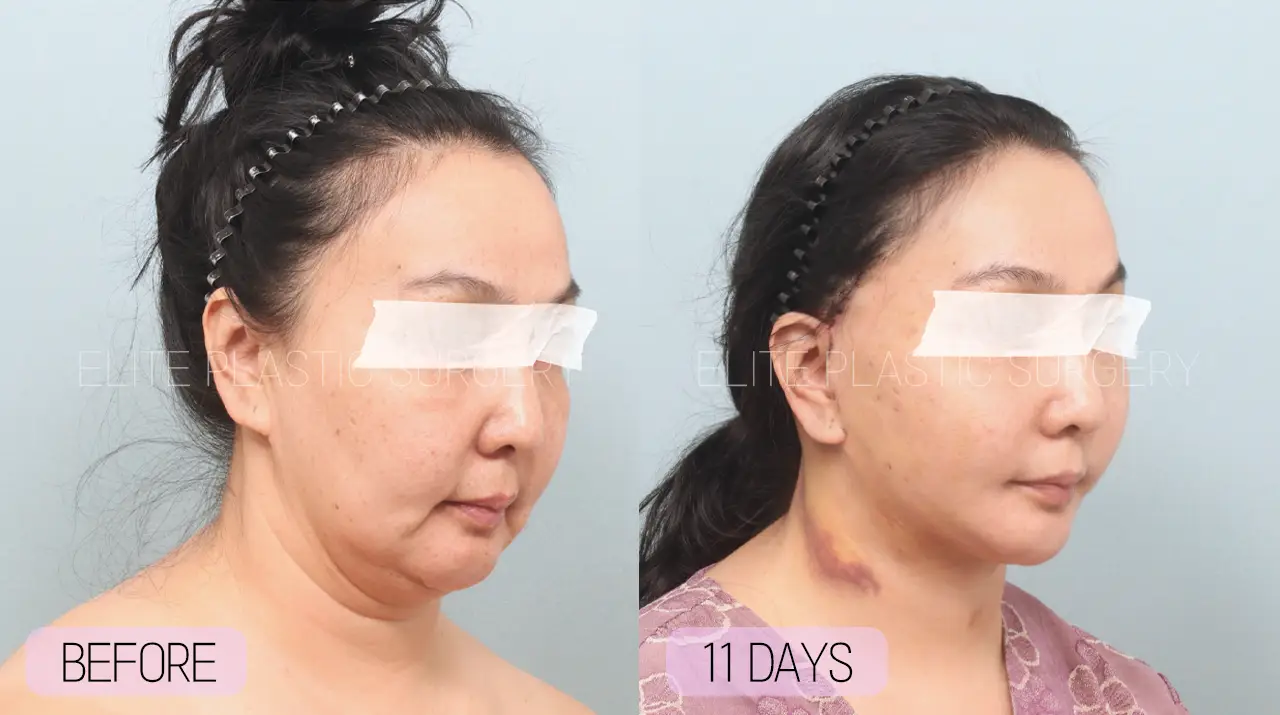 Facelift and Neck Lift in Incheon, South Korea by Elite Plastic Surgery