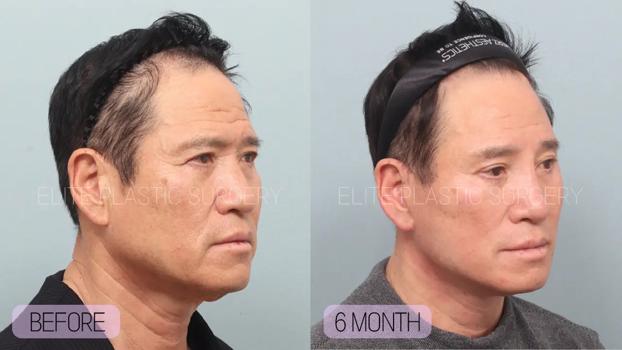 Facelift and Neck Lift in Incheon, South Korea by Elite Plastic Surgery