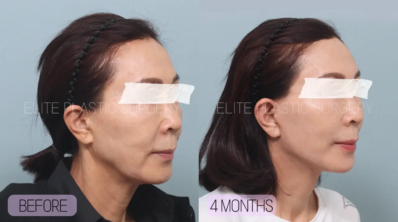 Facelift and Neck Lift in Incheon, South Korea by Elite Plastic Surgery