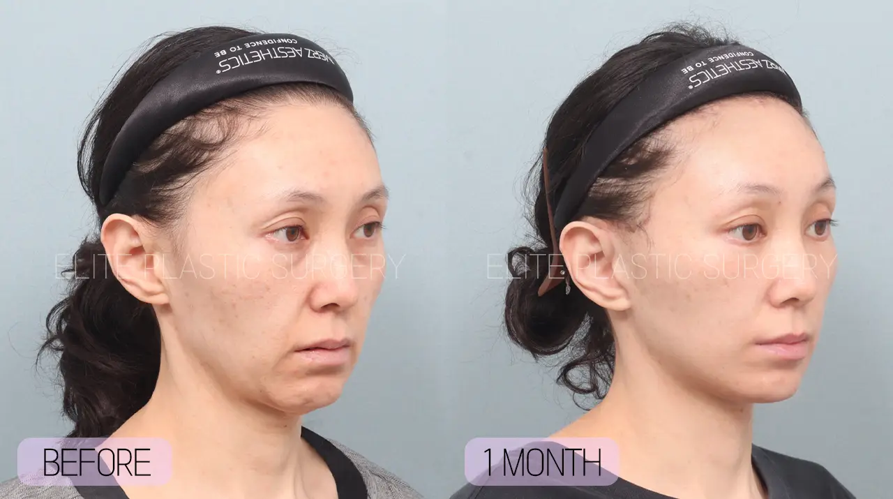 Facelift and Neck Lift in Incheon, South Korea by Elite Plastic Surgery