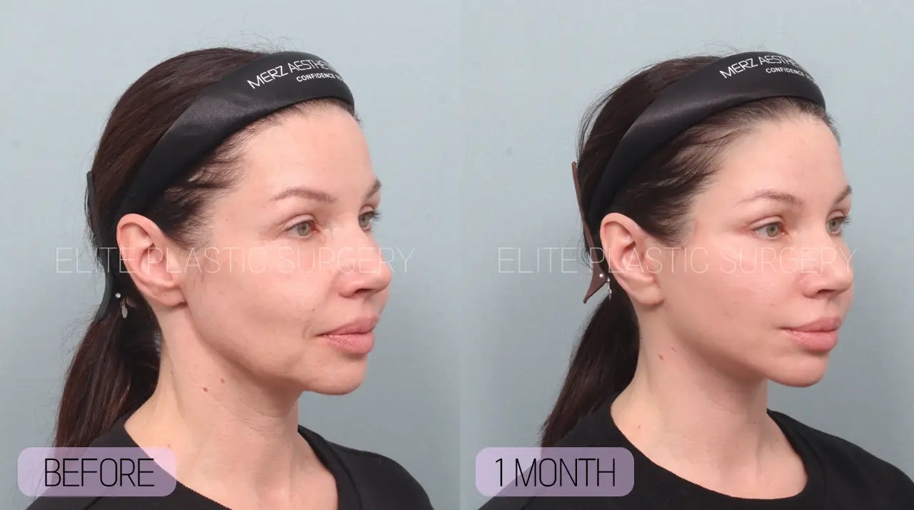 Facelift and Neck Lift in Incheon, South Korea by Elite Plastic Surgery