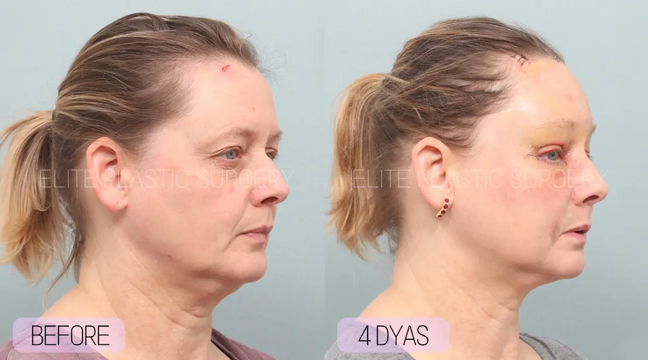 Facelift and Neck Lift in Incheon, South Korea by Elite Plastic Surgery