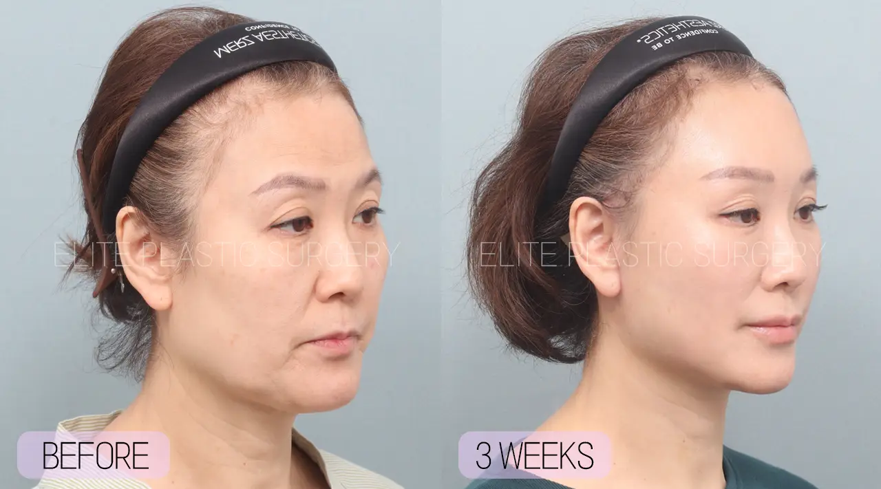 Facelift and Neck Lift in Incheon, South Korea by Elite Plastic Surgery