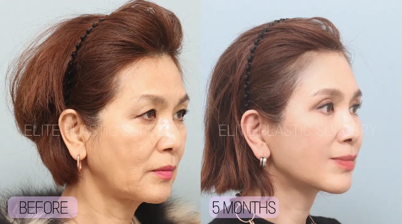 Facelift and Neck Lift in Incheon, South Korea by Elite Plastic Surgery