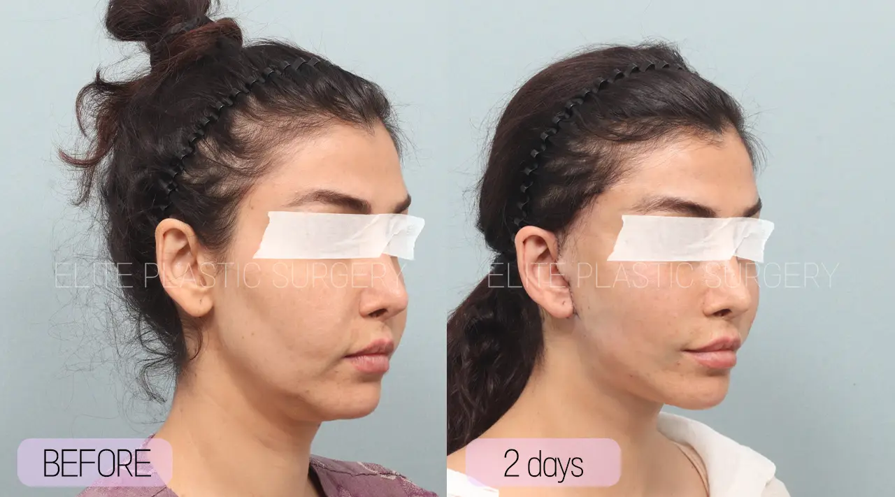 Facelift and Neck Lift in Incheon, South Korea by Elite Plastic Surgery