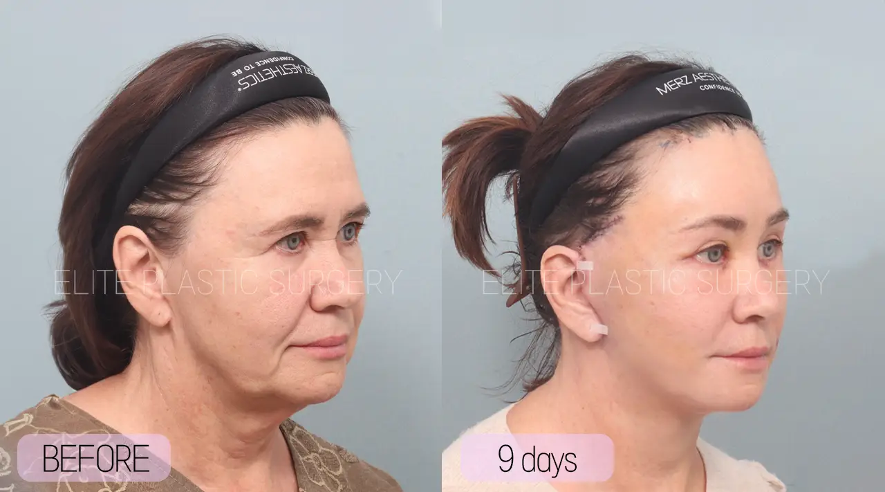 Facelift and Neck Lift in Incheon, South Korea by Elite Plastic Surgery