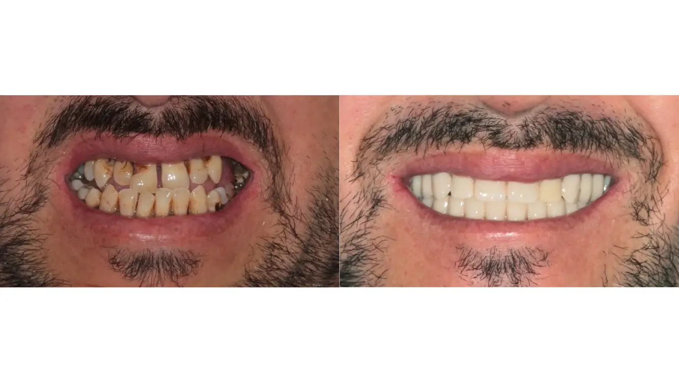 Dental Crown in Bogota, Colombia by Malo Dental