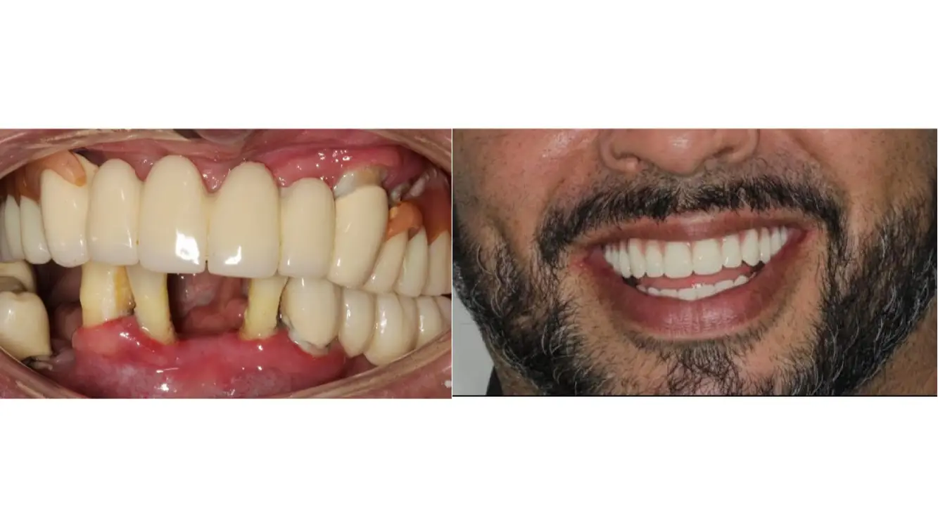 Ceramic Bridge in Bogota, Colombia by Malo Dental
