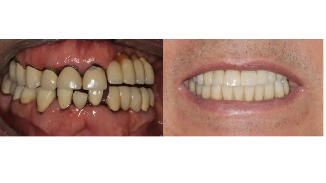 Dental Veneers in Bogota, Colombia by Malo Dental