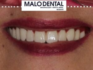 Ceramic Bridge in Bogota, Colombia by Malo Dental — Dentistry in Colombia