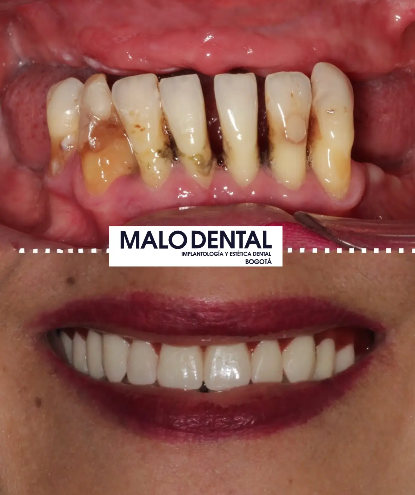 Malo dental clinic meditour implant32
