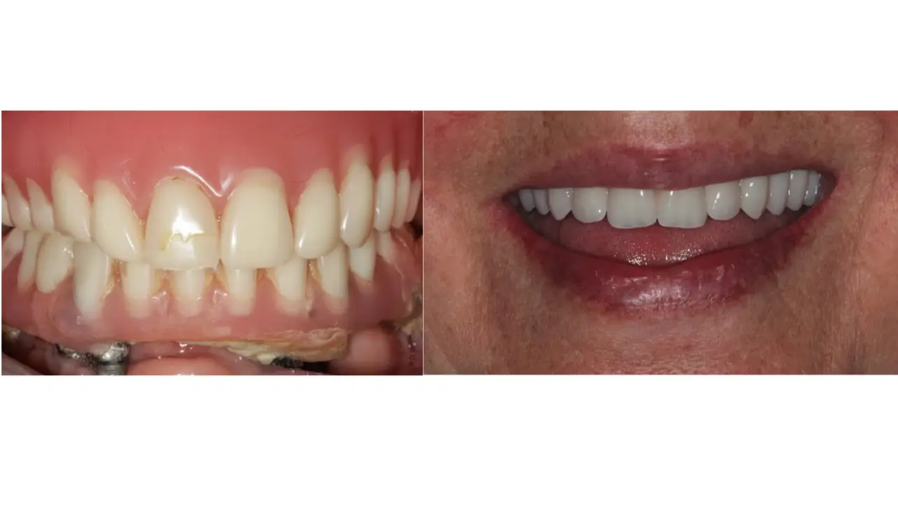 Dental Crown in Bogota, Colombia by Malo Dental