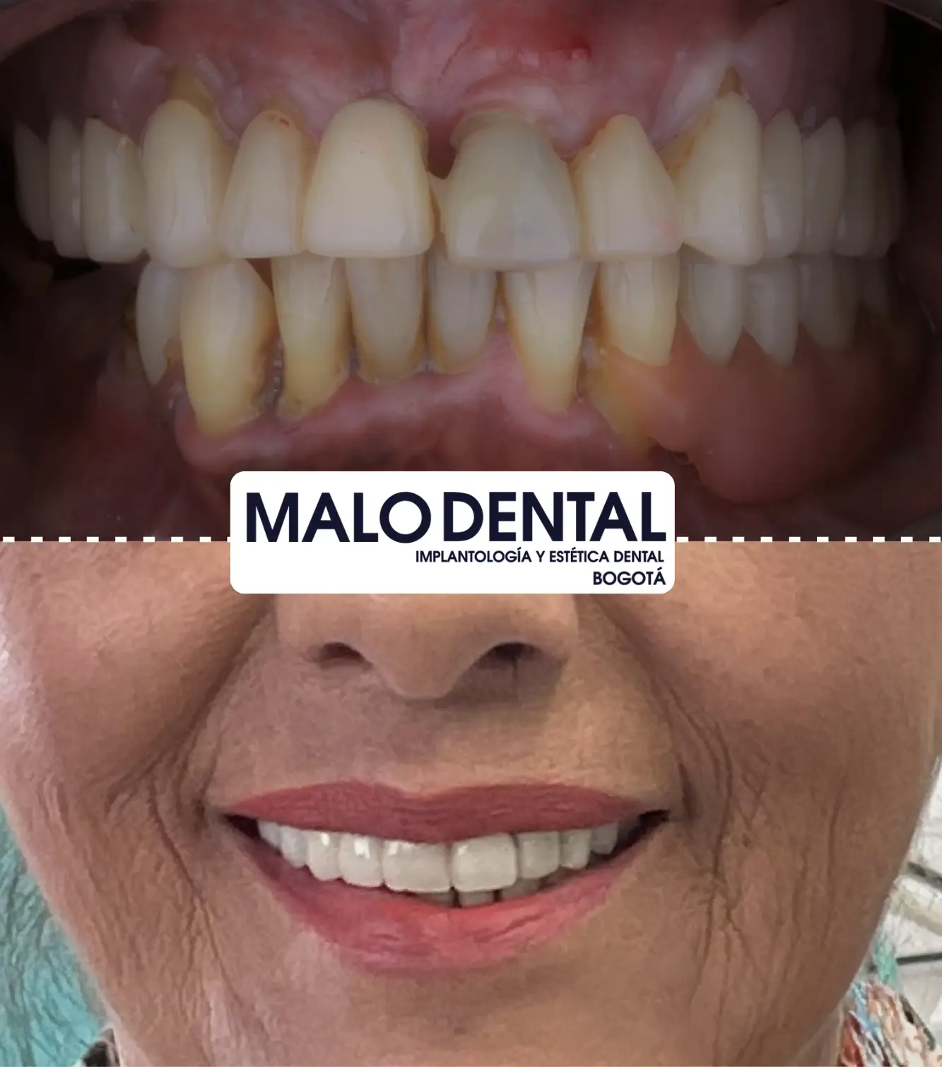Malo dental clinic meditour implants8
